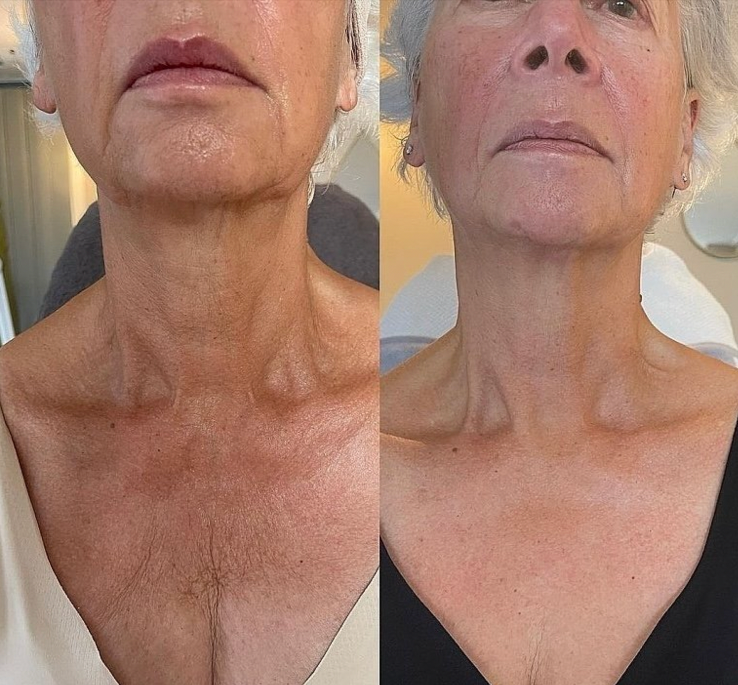 KRX NECK LIFT INTENSIVEFIRMING NECK CREAM